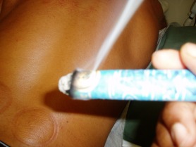 moxibustion